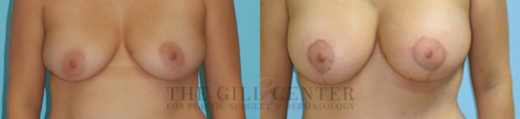 Breast Lift with Implants Case 119 Before & After Front | The Woodlands, TX | The Gill Center for Plastic Surgery and Dermatology