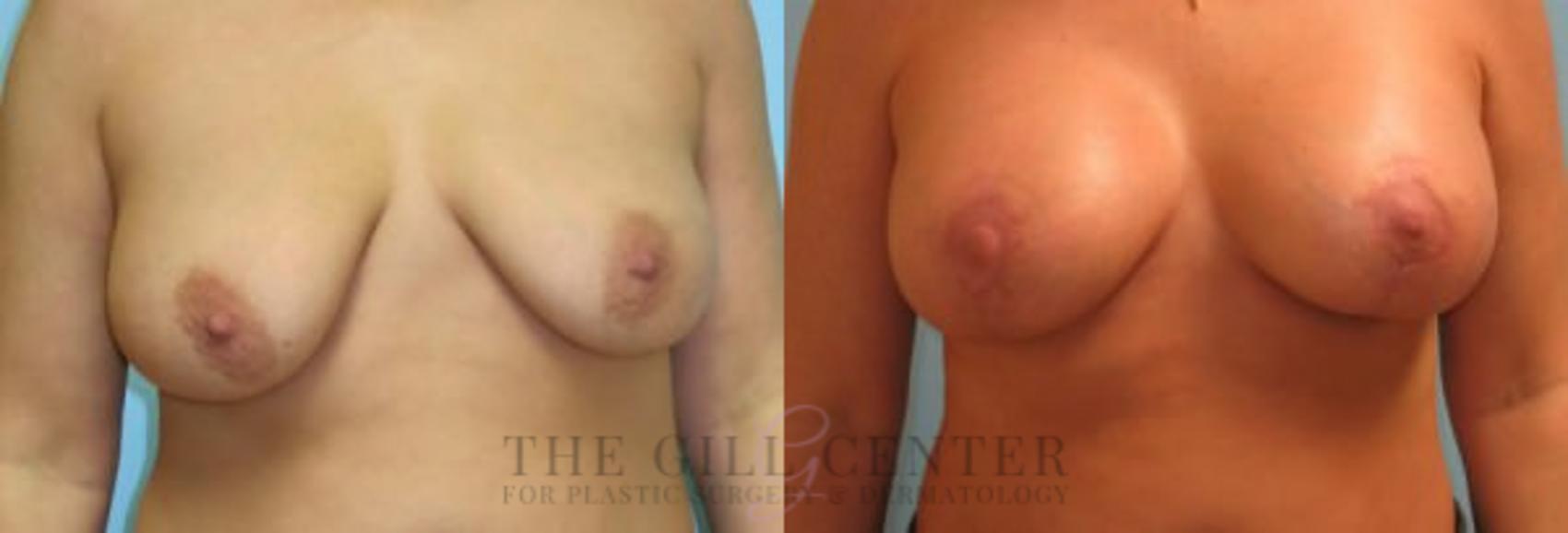 Breast Lift with Implants Case 120 Before & After Front | The Woodlands, TX | The Gill Center for Plastic Surgery and Dermatology