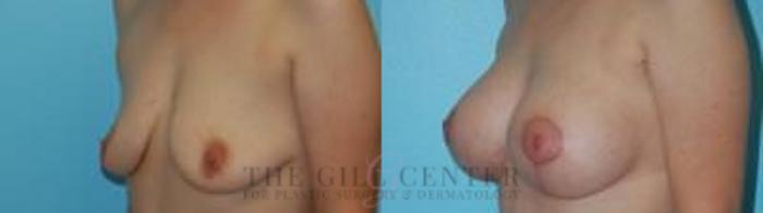 Breast Lift with Implants Case 330 Before & After Left Oblique | The Woodlands, TX | The Gill Center for Plastic Surgery and Dermatology