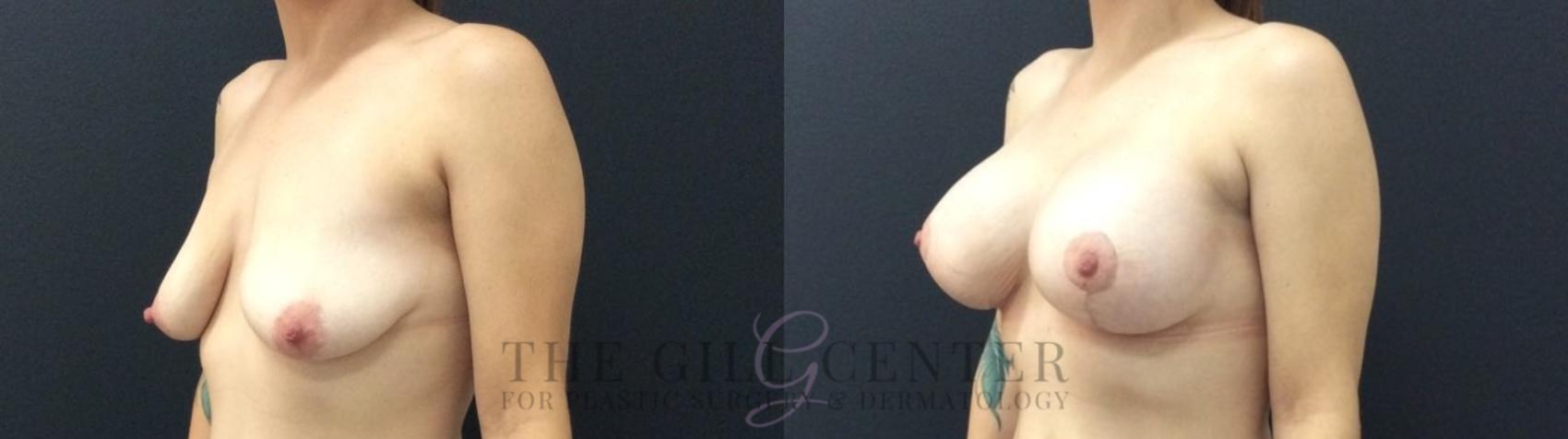 Breast Lift with Implants Case 471 Before & After Left Oblique | The Woodlands, TX | The Gill Center for Plastic Surgery and Dermatology