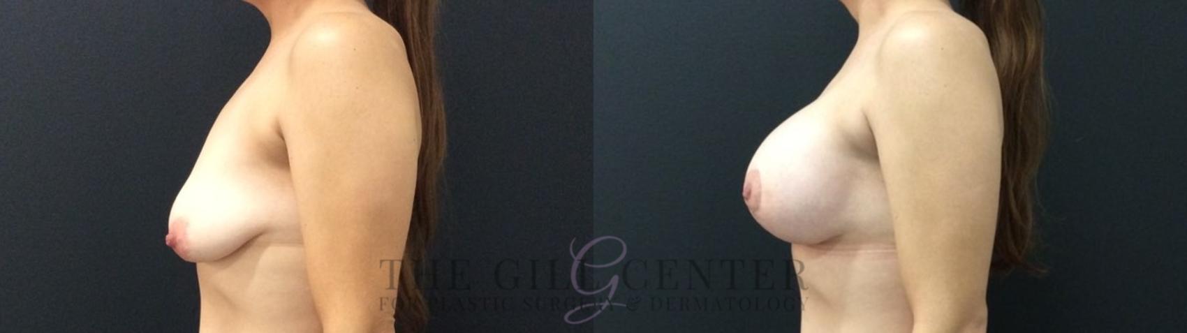 Breast Lift with Implants Case 471 Before & After Left Side | The Woodlands, TX | The Gill Center for Plastic Surgery and Dermatology