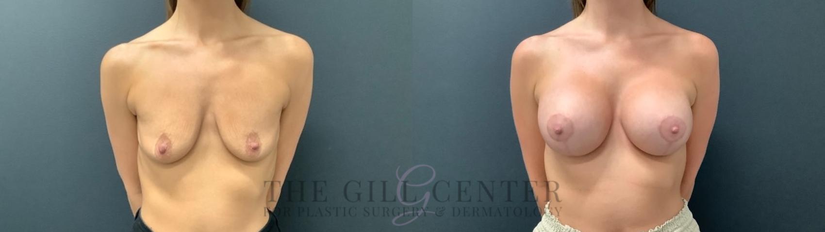 Breast Lift with Implants Case 535 Before & After Front | The Woodlands, TX | The Gill Center for Plastic Surgery and Dermatology