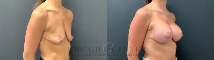 Breast Lift with Implants Case 535 Before & After Right Oblique | The Woodlands, TX | The Gill Center for Plastic Surgery and Dermatology