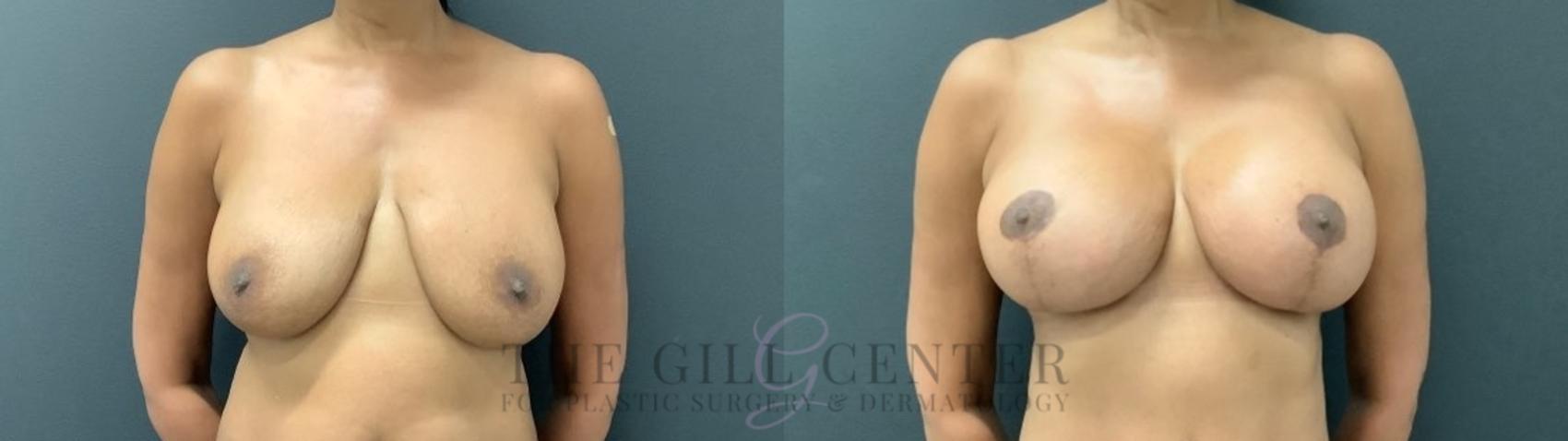 Breast Lift with Implants Case 544 Before & After Front | The Woodlands, TX | The Gill Center for Plastic Surgery and Dermatology