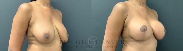 Breast Lift with Implants Case 544 Before & After Right Oblique | The Woodlands, TX | The Gill Center for Plastic Surgery and Dermatology