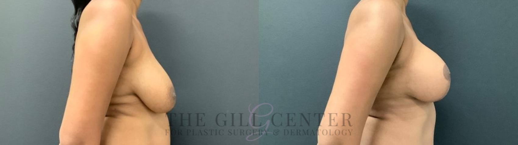Breast Lift with Implants Case 544 Before & After Right Side | The Woodlands, TX | The Gill Center for Plastic Surgery and Dermatology