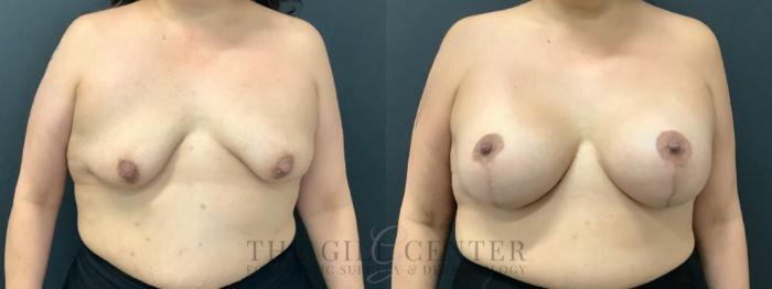 Breast Lift with Implants Case 596 Before & After Front | The Woodlands, TX | The Gill Center for Plastic Surgery and Dermatology
