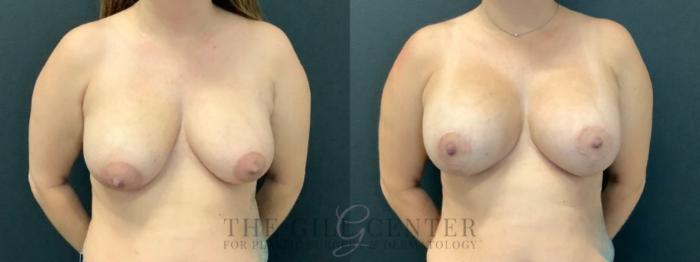 Breast Lift with Implants Case 598 Before & After Front | The Woodlands, TX | The Gill Center for Plastic Surgery and Dermatology