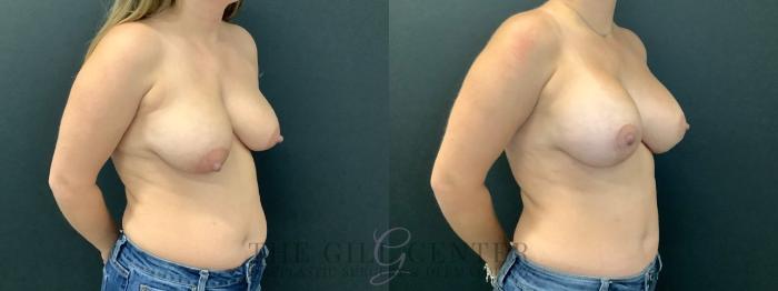 Breast Lift with Implants Case 598 Before & After Right Oblique | The Woodlands, TX | The Gill Center for Plastic Surgery and Dermatology