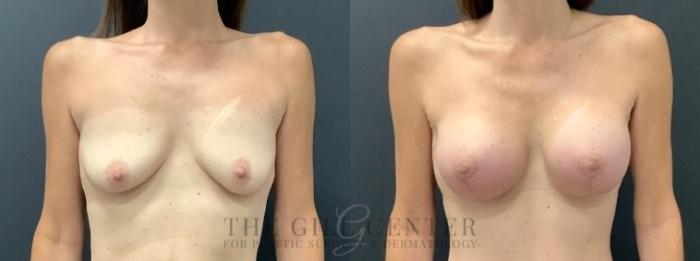 Breast Lift with Implants Case 599 Before & After Front | The Woodlands, TX | The Gill Center for Plastic Surgery and Dermatology