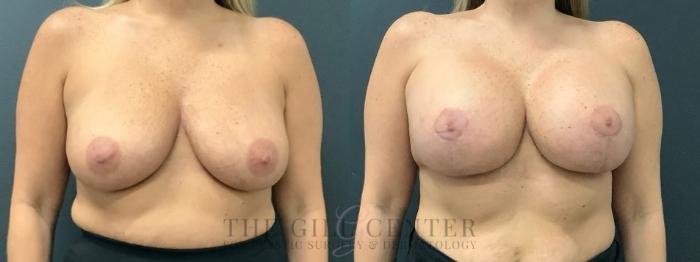 Breast Lift with Implants Case 614 Before & After Front | The Woodlands, TX | The Gill Center for Plastic Surgery and Dermatology