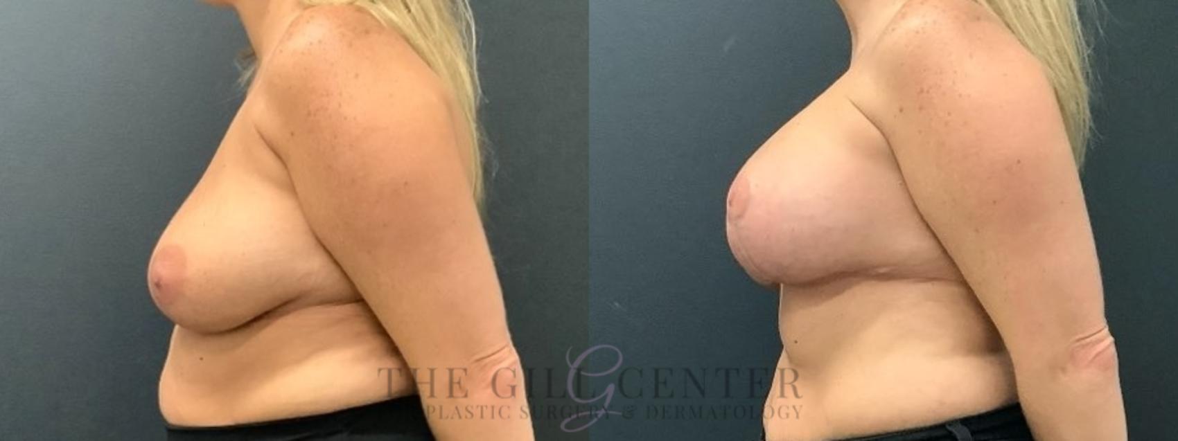 Breast Lift with Implants Case 614 Before & After Left Side | The Woodlands, TX | The Gill Center for Plastic Surgery and Dermatology