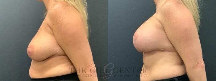 Breast Lift with Implants Case 614 Before & After Left Side | The Woodlands, TX | The Gill Center for Plastic Surgery and Dermatology