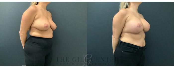 Breast Lift with Implants Case 614 Before & After Right Oblique | The Woodlands, TX | The Gill Center for Plastic Surgery and Dermatology