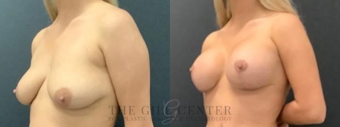 Breast Lift with Implants Case 623 Before & After Left Oblique | The Woodlands, TX | The Gill Center for Plastic Surgery and Dermatology