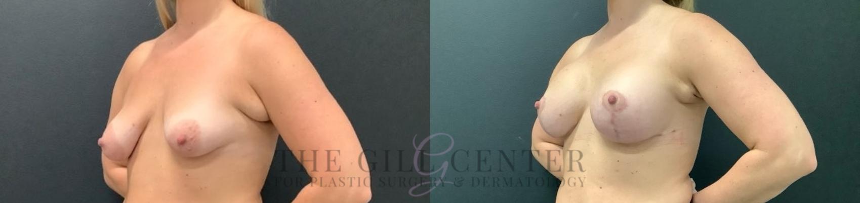 Breast Lift with Implants Case 624 Before & After Left Oblique | The Woodlands, TX | The Gill Center for Plastic Surgery and Dermatology