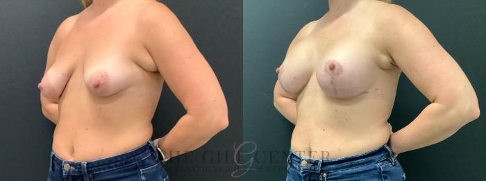 Breast Lift with Implants Case 624 Before & After Left Oblique | The Woodlands, TX | The Gill Center for Plastic Surgery and Dermatology