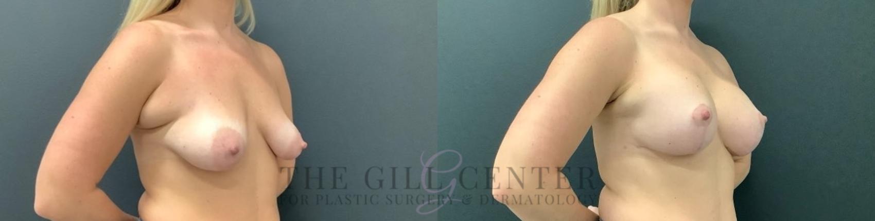 Breast Lift with Implants Case 624 Before & After Right Oblique | The Woodlands, TX | The Gill Center for Plastic Surgery and Dermatology