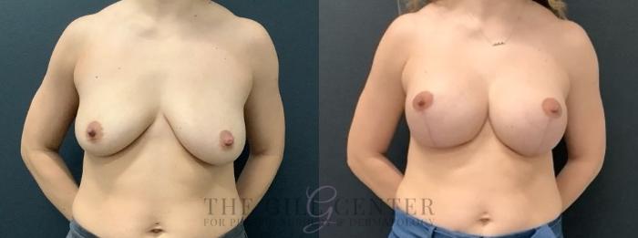 Breast Lift with Implants Case 630 Before & After Front | The Woodlands, TX | The Gill Center for Plastic Surgery and Dermatology