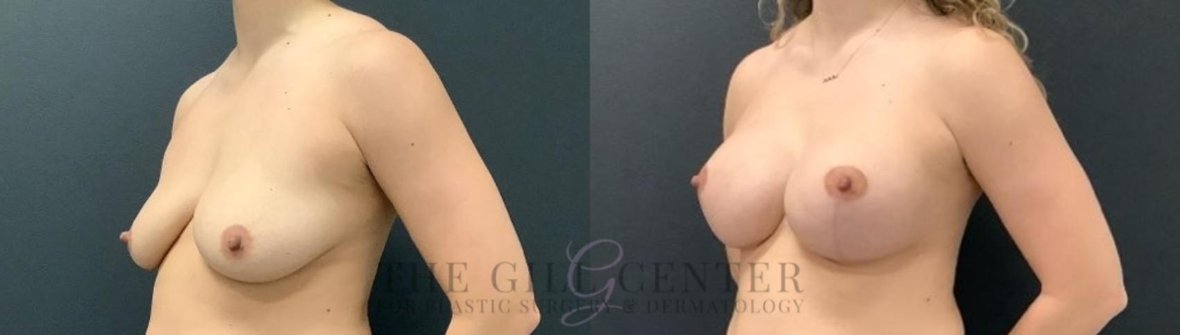 Breast Lift with Implants Case 630 Before & After Left Oblique | The Woodlands, TX | The Gill Center for Plastic Surgery and Dermatology