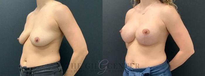 Breast Lift with Implants Case 630 Before & After Left Oblique | The Woodlands, TX | The Gill Center for Plastic Surgery and Dermatology