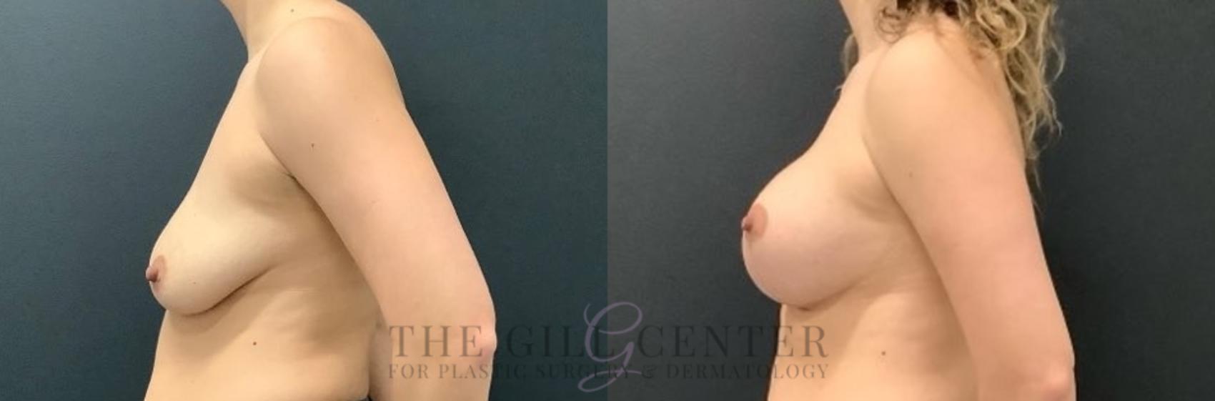 Breast Lift with Implants Case 630 Before & After Left Side | The Woodlands, TX | The Gill Center for Plastic Surgery and Dermatology