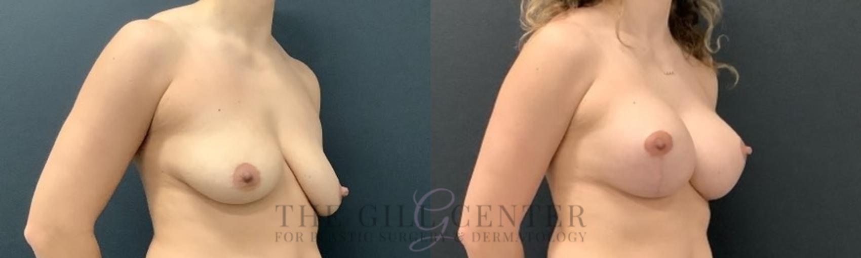 Breast Lift with Implants Case 630 Before & After Right Oblique | The Woodlands, TX | The Gill Center for Plastic Surgery and Dermatology