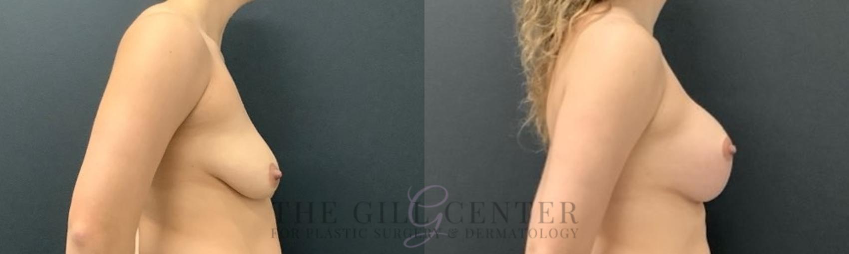 Breast Lift with Implants Case 630 Before & After Right Side | The Woodlands, TX | The Gill Center for Plastic Surgery and Dermatology