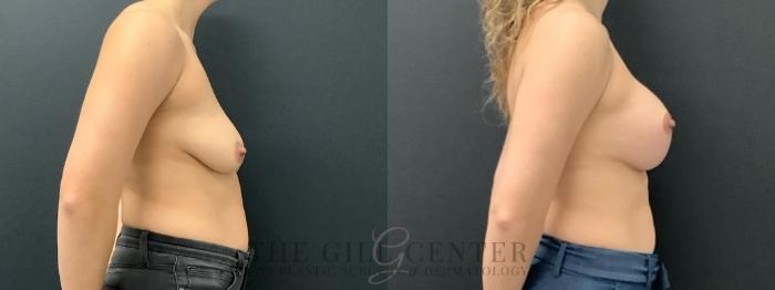 Breast Lift with Implants Case 630 Before & After Right Side | The Woodlands, TX | The Gill Center for Plastic Surgery and Dermatology