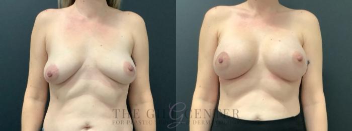 Breast Lift with Implants Case 632 Before & After Front | The Woodlands, TX | The Gill Center for Plastic Surgery and Dermatology