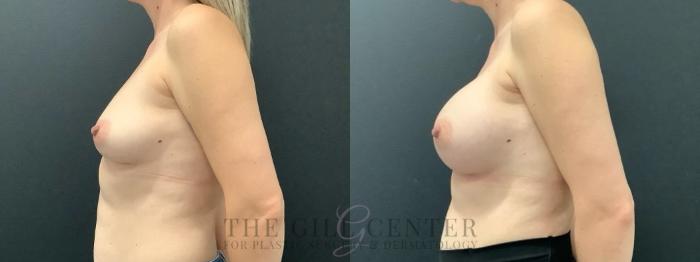 Breast Lift with Implants Case 632 Before & After Left Side | The Woodlands, TX | The Gill Center for Plastic Surgery and Dermatology