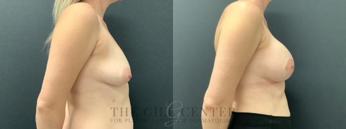 Breast Lift with Implants Case 632 Before & After Right Side | The Woodlands, TX | The Gill Center for Plastic Surgery and Dermatology