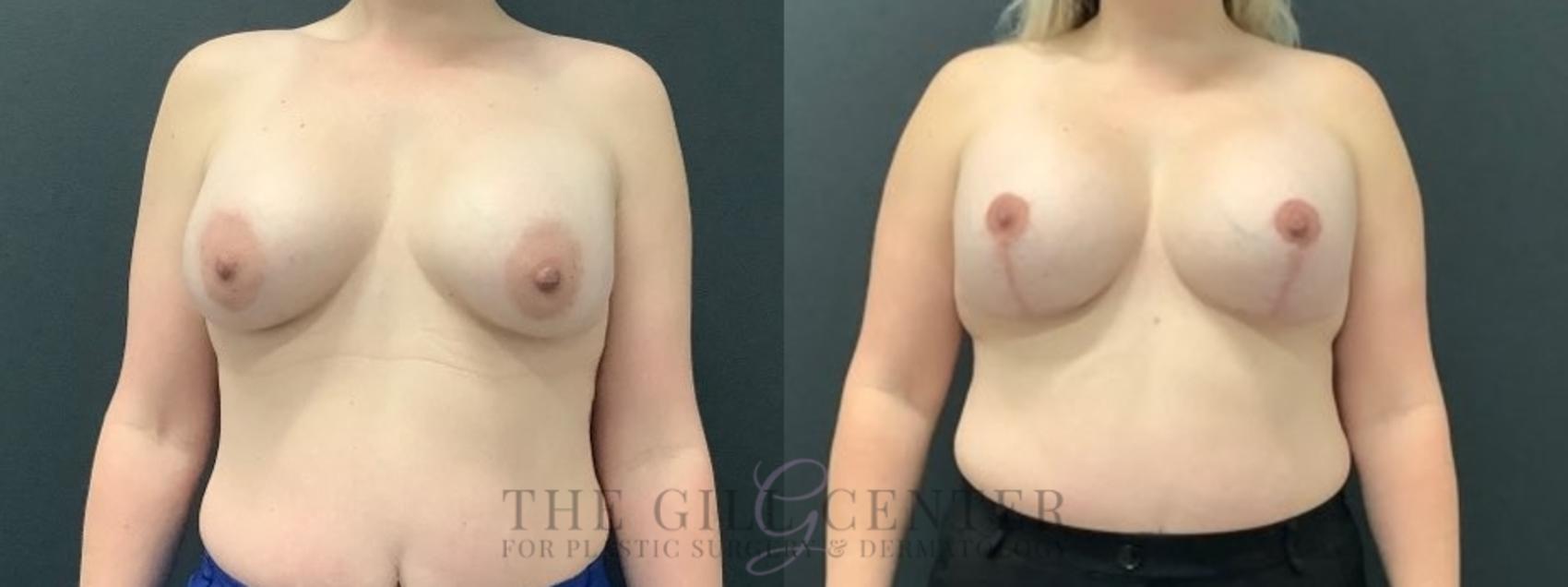 Breast Lift with Implants Case 639 Before & After Front | The Woodlands, TX | The Gill Center for Plastic Surgery and Dermatology