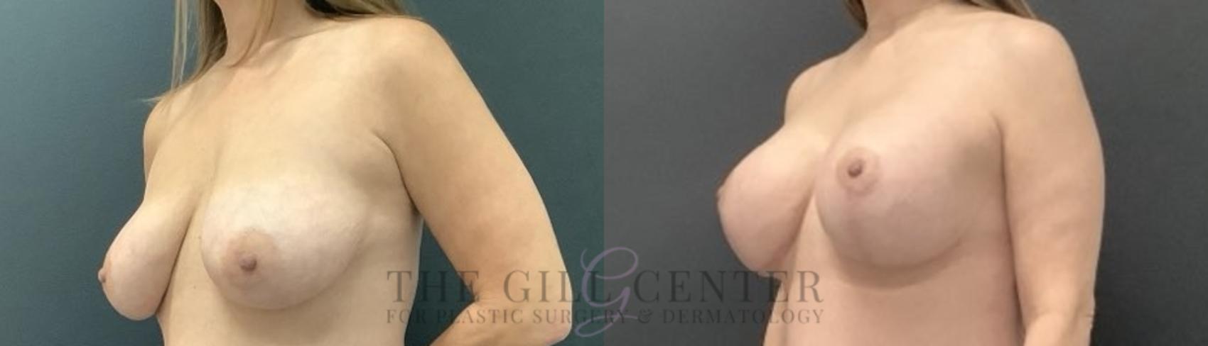 Breast Lift with Implants Case 672 Before & After Left Oblique | The Woodlands, TX | The Gill Center for Plastic Surgery and Dermatology