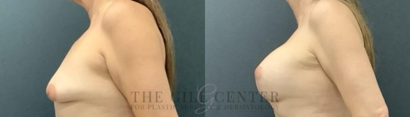 Breast Lift with Implants Case 676 Before & After Left Side | The Woodlands, TX | The Gill Center for Plastic Surgery and Dermatology