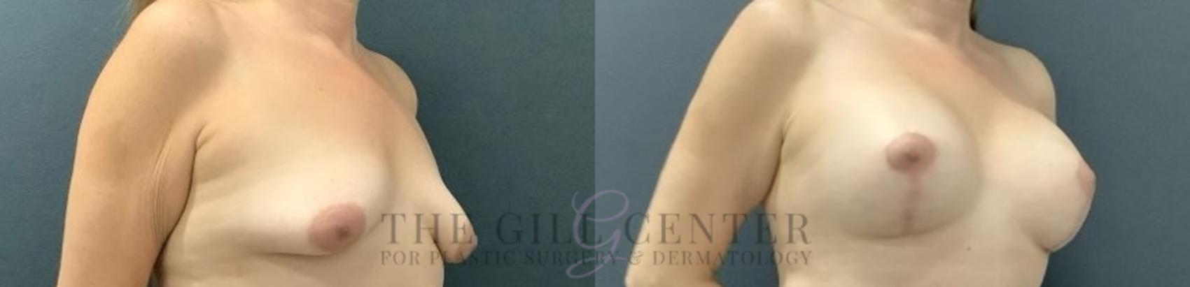 Breast Lift with Implants Case 676 Before & After Right Oblique | The Woodlands, TX | The Gill Center for Plastic Surgery and Dermatology