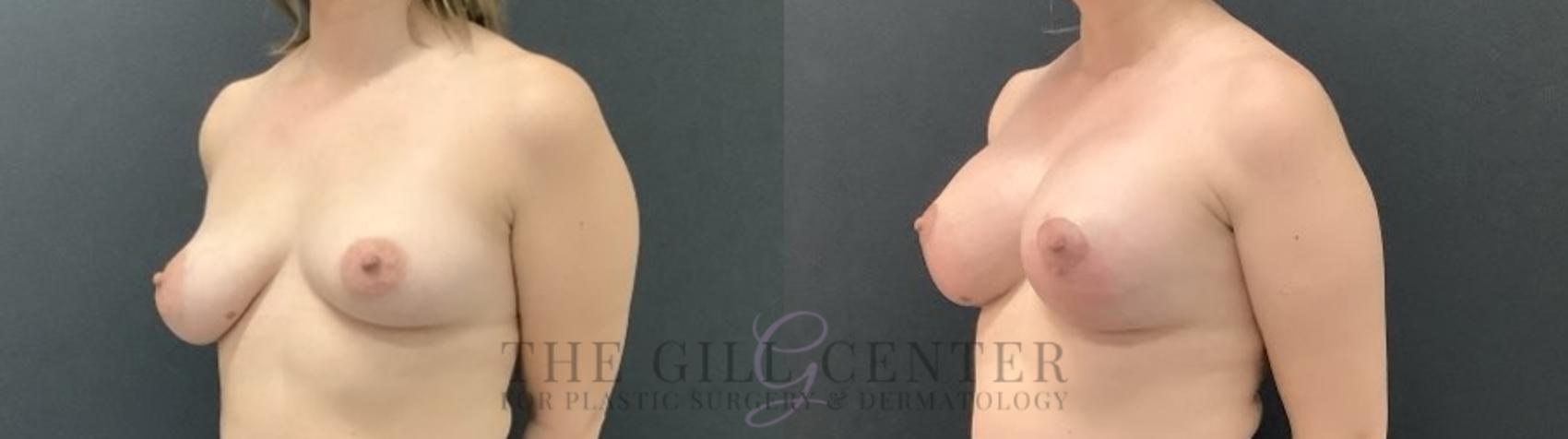 Breast Lift with Implants Case 682 Before & After Left Oblique | The Woodlands, TX | The Gill Center for Plastic Surgery and Dermatology