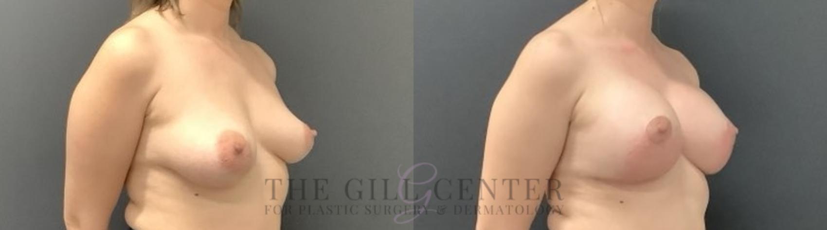 Breast Lift with Implants Case 682 Before & After Right Oblique | The Woodlands, TX | The Gill Center for Plastic Surgery and Dermatology