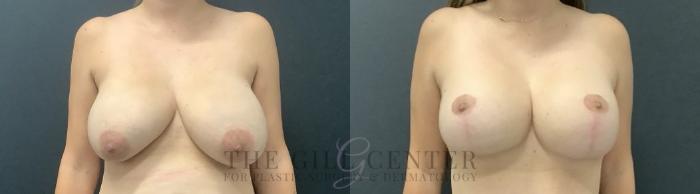 Breast Lift with Implants Case 691 Before & After Front | The Woodlands, TX | The Gill Center for Plastic Surgery and Dermatology