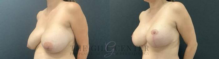 Breast Lift with Implants Case 691 Before & After Left Side | The Woodlands, TX | The Gill Center for Plastic Surgery and Dermatology