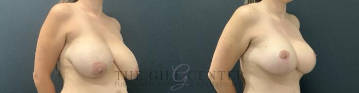 Breast Lift with Implants Case 691 Before & After Right Side | The Woodlands, TX | The Gill Center for Plastic Surgery and Dermatology