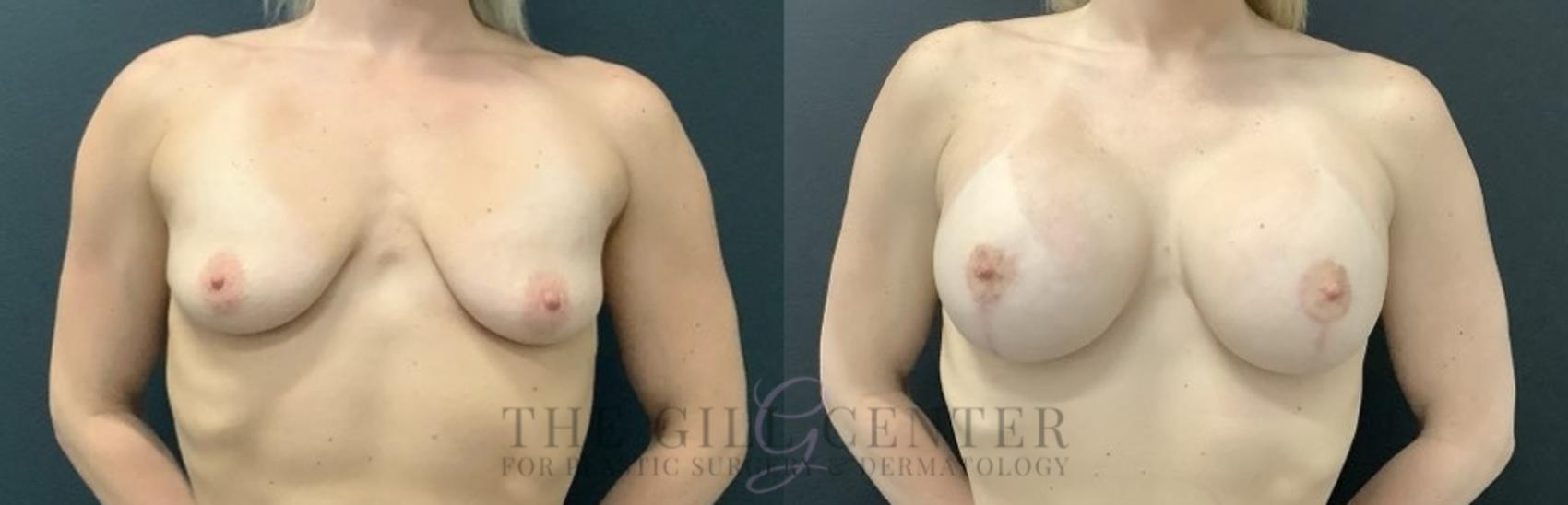 Breast Lift with Implants Case 694 Before & After Front | The Woodlands, TX | The Gill Center for Plastic Surgery and Dermatology
