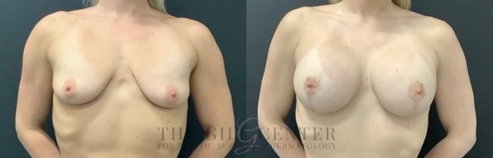 Breast Lift with Implants Case 694 Before & After Front | The Woodlands, TX | The Gill Center for Plastic Surgery and Dermatology