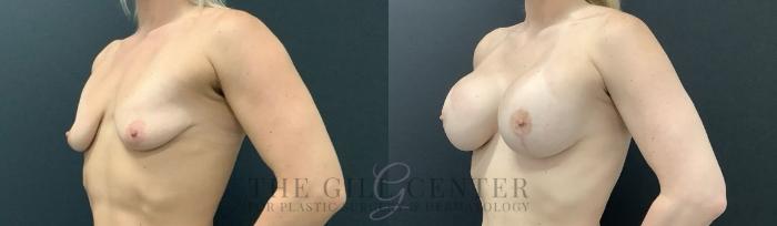 Breast Lift with Implants Case 694 Before & After Left Side | The Woodlands, TX | The Gill Center for Plastic Surgery and Dermatology