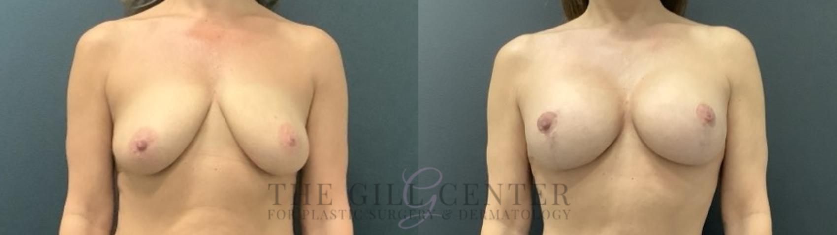 Breast Lift with Implants Case 695 Before & After Front | The Woodlands, TX | The Gill Center for Plastic Surgery and Dermatology