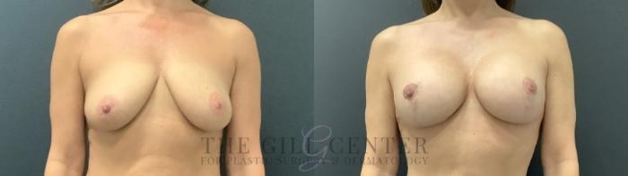 Breast Lift with Implants Case 695 Before & After Front | The Woodlands, TX | The Gill Center for Plastic Surgery and Dermatology