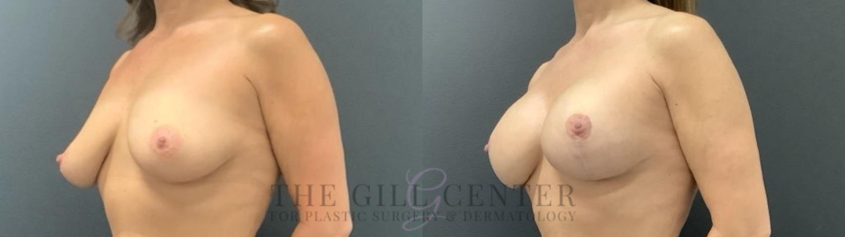 Breast Lift with Implants Case 695 Before & After Left Side | The Woodlands, TX | The Gill Center for Plastic Surgery and Dermatology