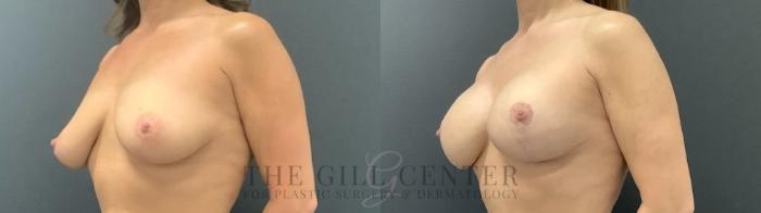 Breast Lift with Implants Case 695 Before & After Left Side | The Woodlands, TX | The Gill Center for Plastic Surgery and Dermatology