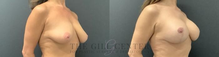 Breast Lift with Implants Case 695 Before & After Right Side | The Woodlands, TX | The Gill Center for Plastic Surgery and Dermatology