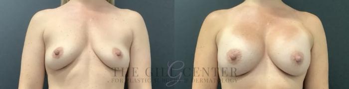 Breast Lift with Implants Case 704 Before & After Front | The Woodlands, TX | The Gill Center for Plastic Surgery and Dermatology